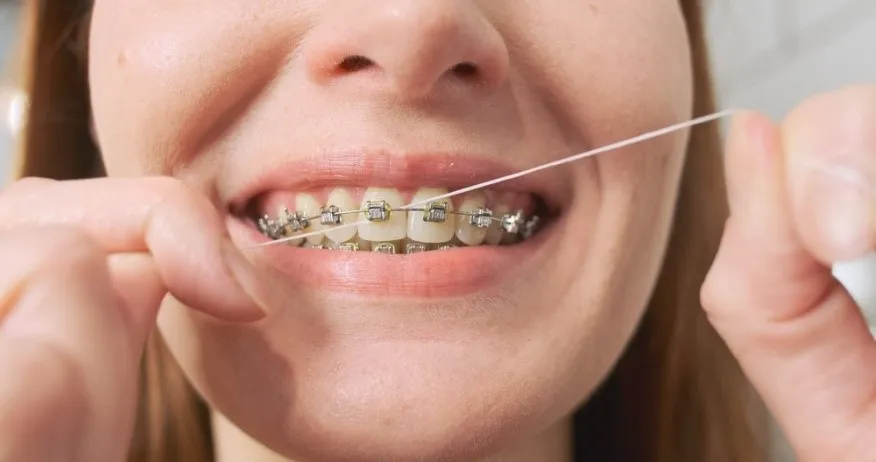 How Braces Increase Cavity Risk