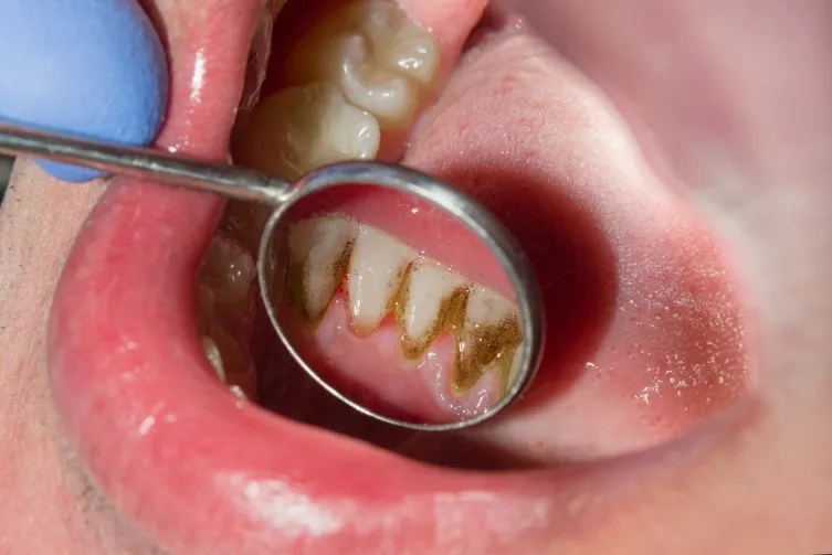 How Can Your Routine and Health Influence Bad Breath?