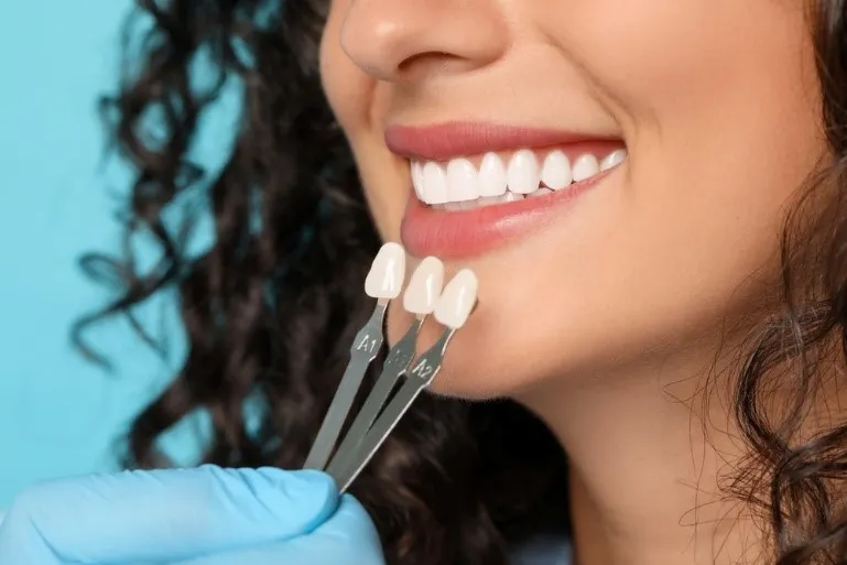 How Do Veneers Look After 10 Years?