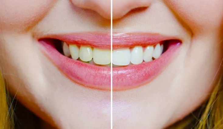 Professional Teeth Whitening 