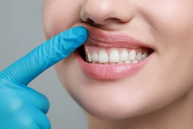 Gum Contouring