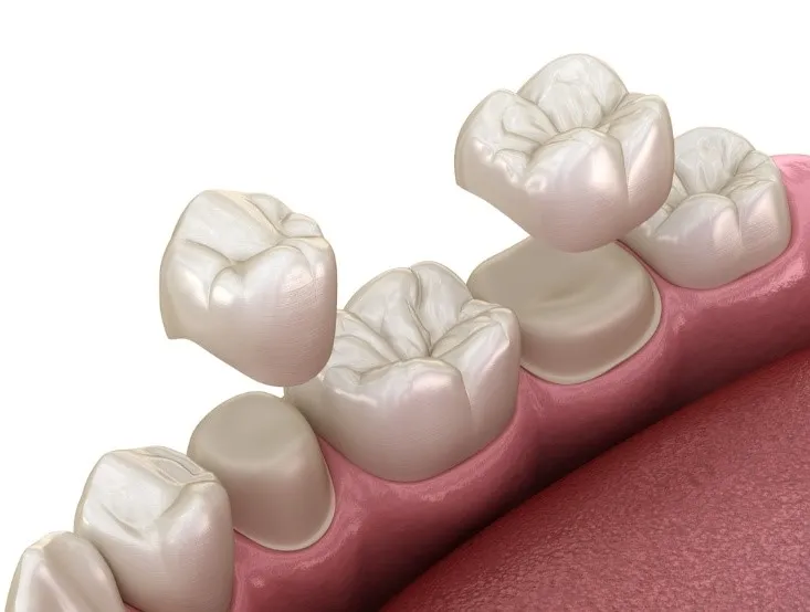 Symptoms of Crown Sensitivity