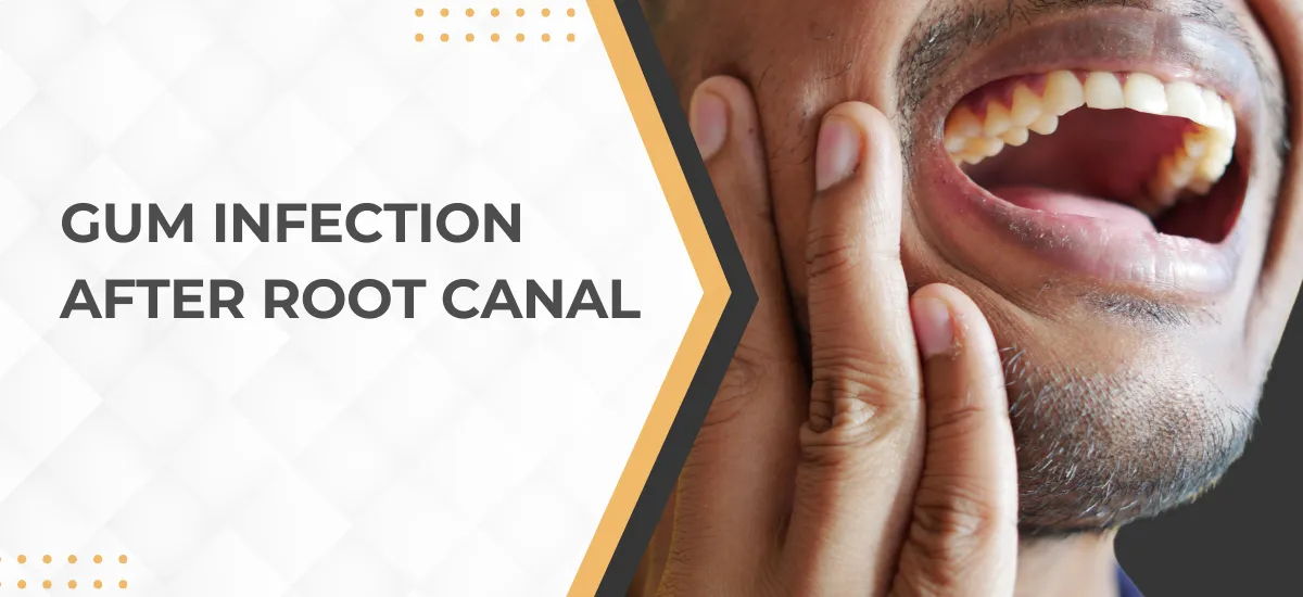 Gum Infection After Root Canal