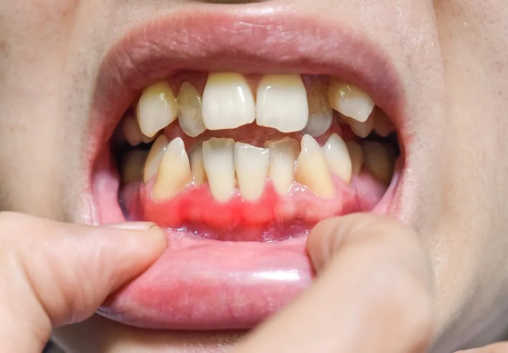 Gum Infection After Root Canal