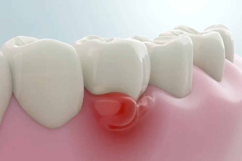 Gum Infection After Root Canal