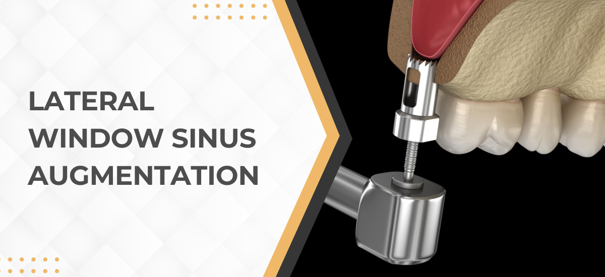 Lateral-Window-Sinus-Augmentation