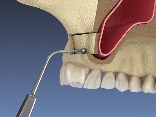 Lateral Window Sinus Augmentation Necessary