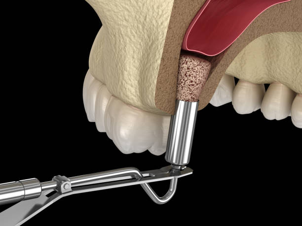 Lateral Window Sinus Lift Procedure