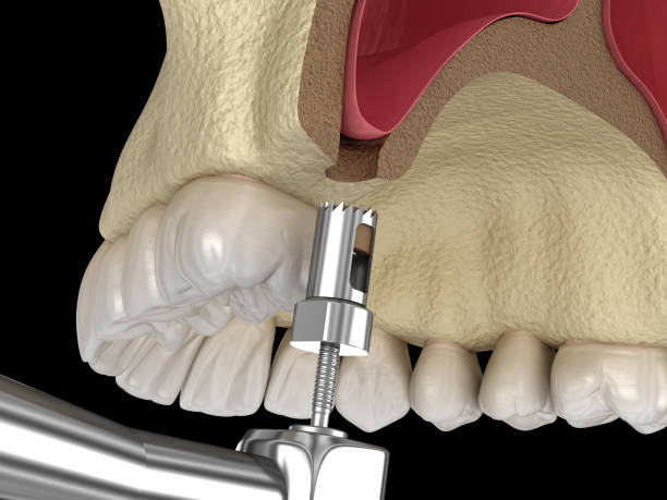 Healing Time After a Lateral Sinus Lift