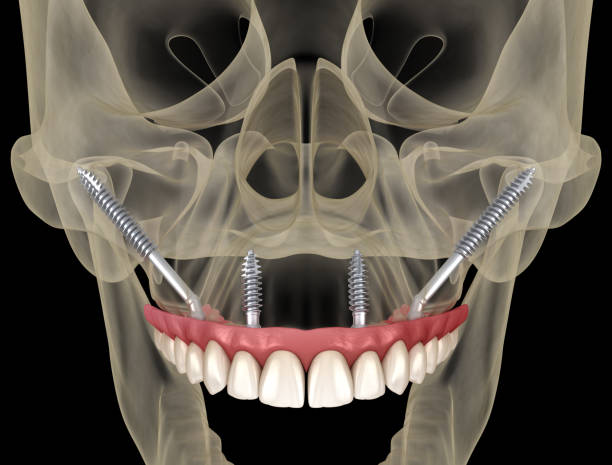 Lateral Window Sinus Lift Procedure