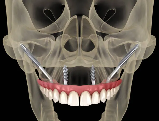 Lateral Window Sinus Lift Procedure