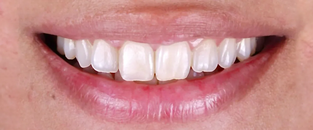 Painless Non-Surgical Dental Procedures For A Stunning Smile