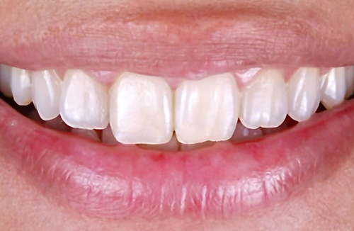 Painless Non-Surgical Dental Procedures For A Stunning Smile