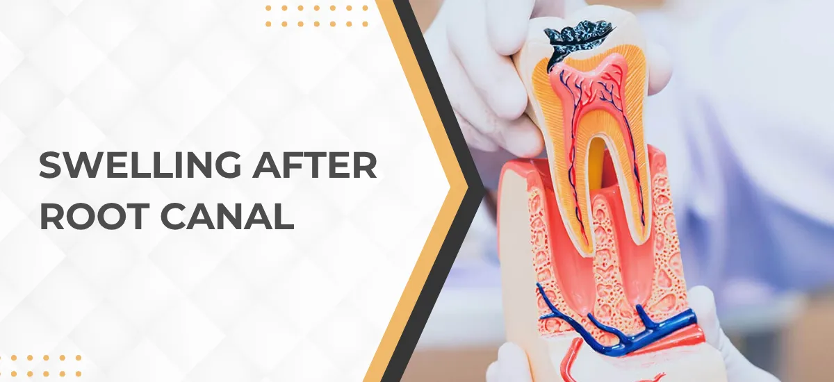 Swelling after Root Canal