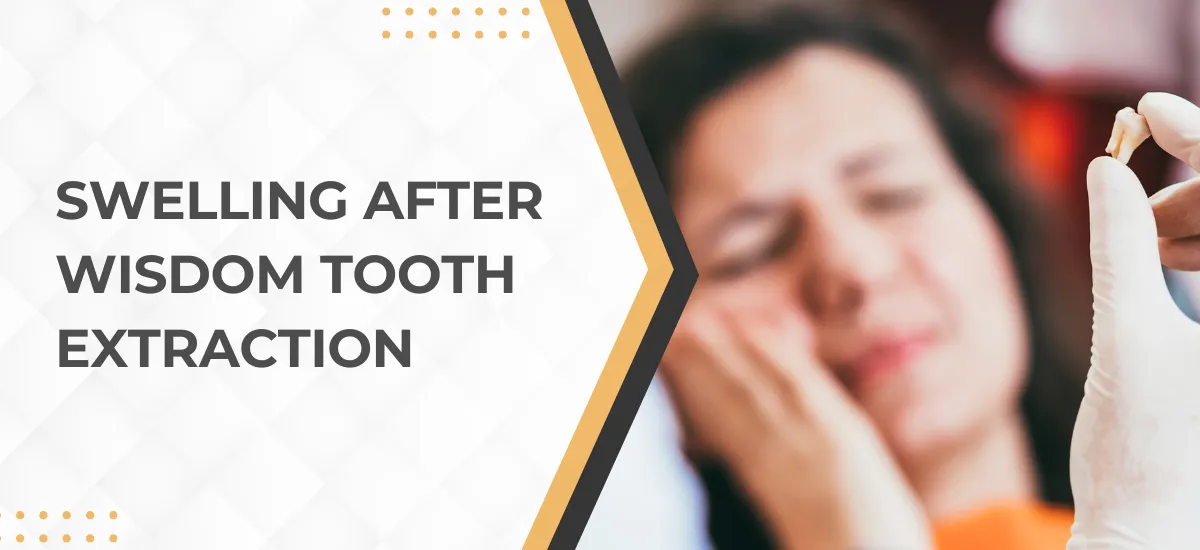 Swelling After Wisdom Tooth Extraction