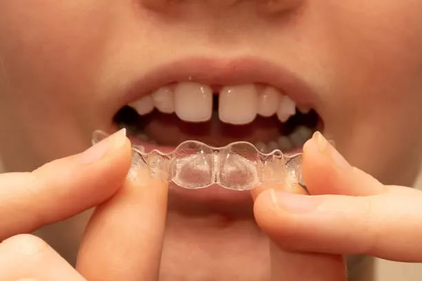Clear Aligners Cost in Mumbai