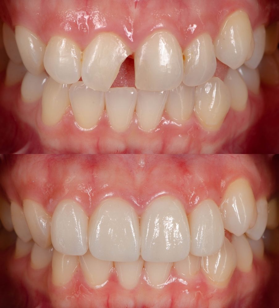 Dental Bonding Benefits