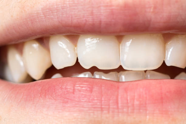 Need For Dental Bonding