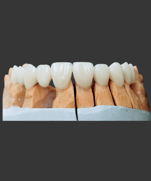 Need for Crowns and Bridges
