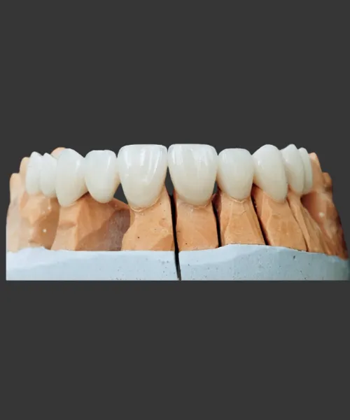 Need for Crowns and Bridges