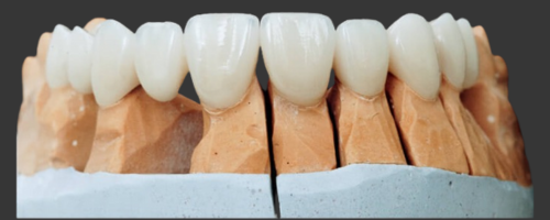 Need for Crowns and Bridges