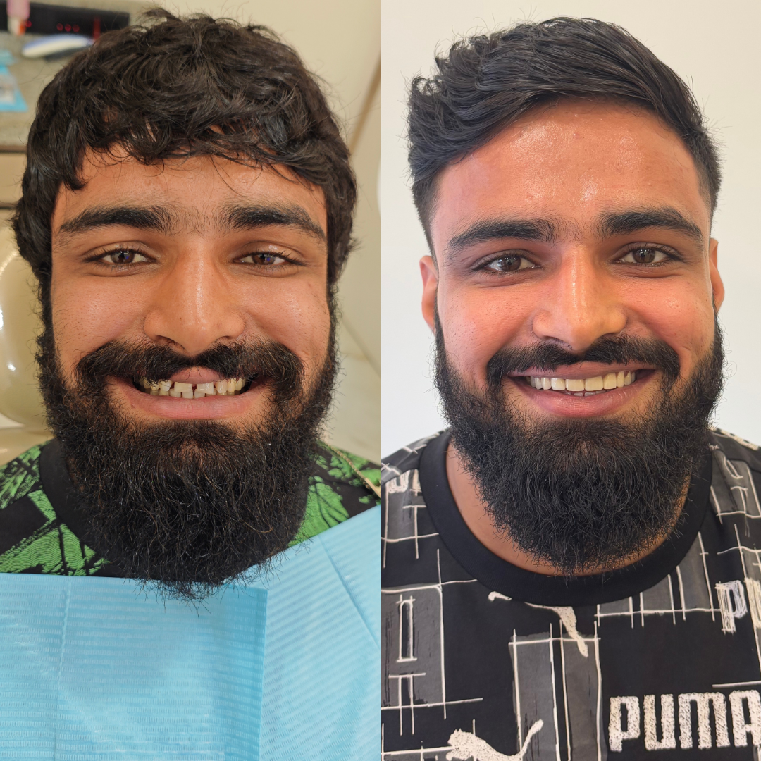 Digital Smile Design In Bandra