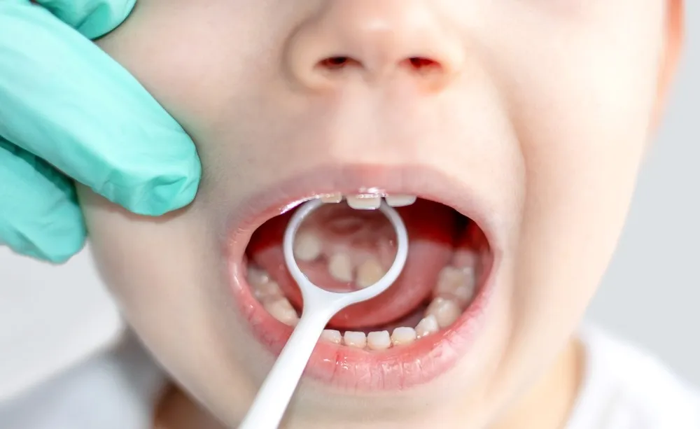 Pediatric Dentistry In Bandra