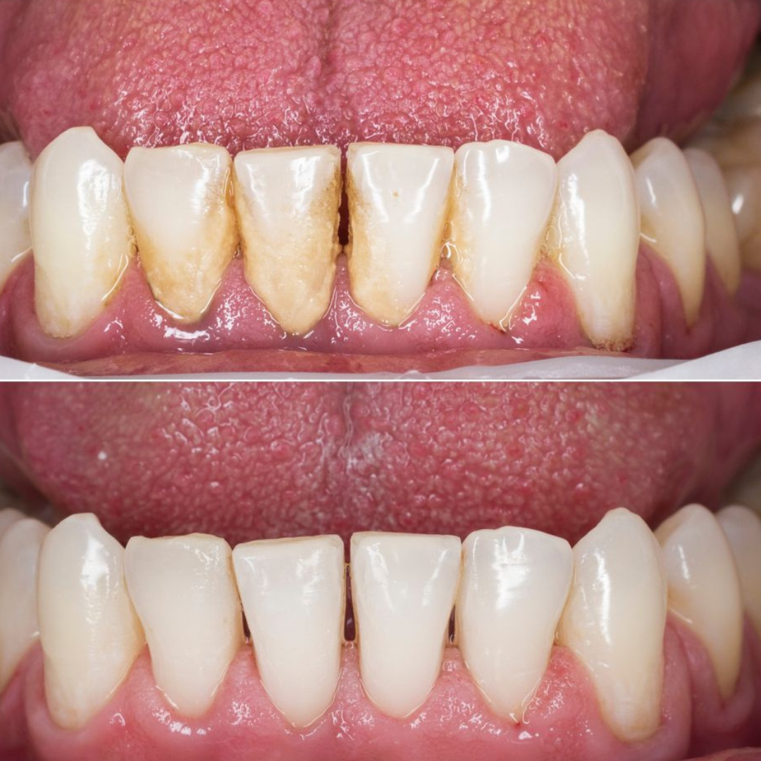 TEETH CLEANING BEFORE AND AFTER