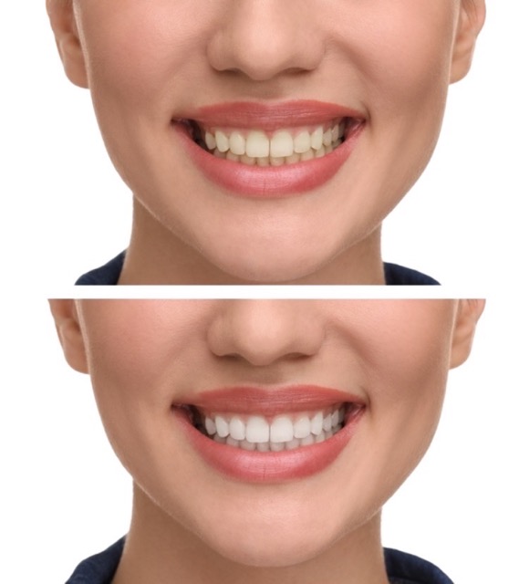 Need For Teeth Whitening