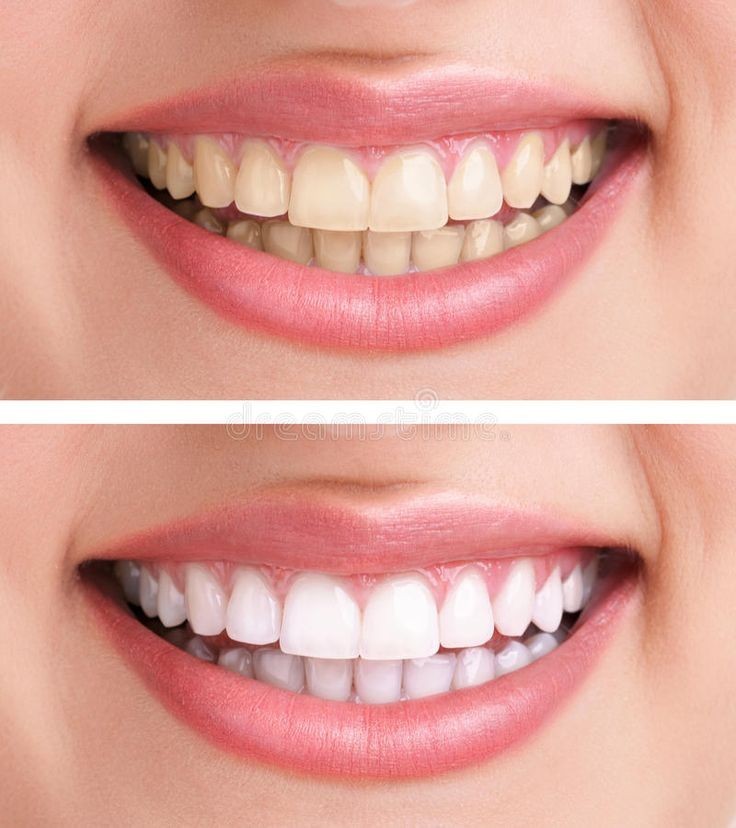 Need For Teeth Whitening
