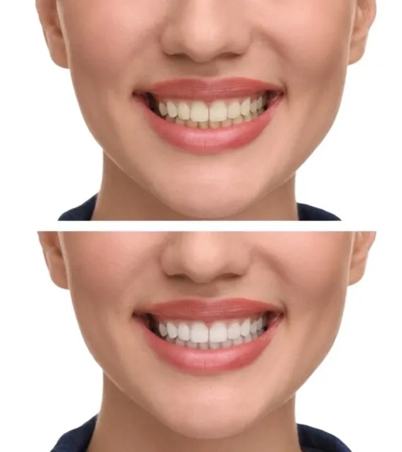 Need For Teeth Whitening