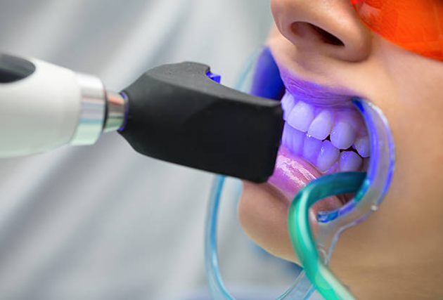 Process Of Teeth Whitening