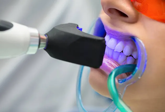 Process Of Teeth Whitening