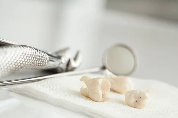 Cost of Wisdom Tooth Extraction