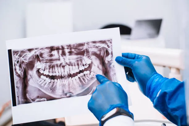 Procedure of Wisdom Tooth Extraction