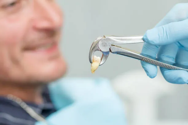 Wisdom Tooth Extraction